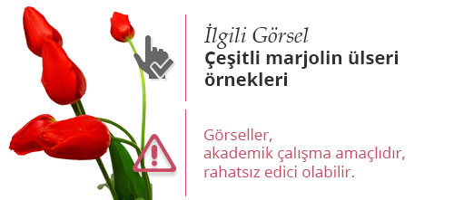 Çeşitli marjolin ülseri örnekleri